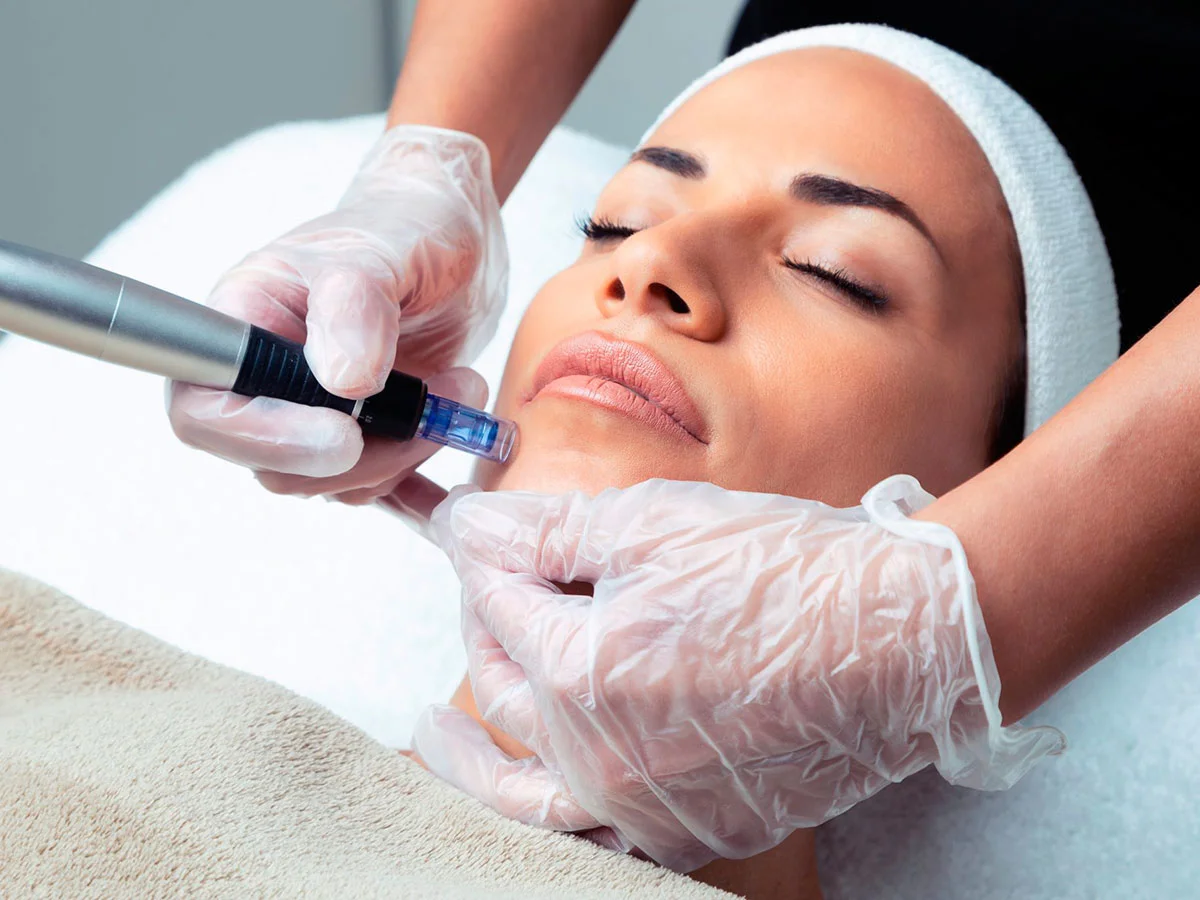 Dermapen - Tratamiento estética Callosa d'en Sarrià
